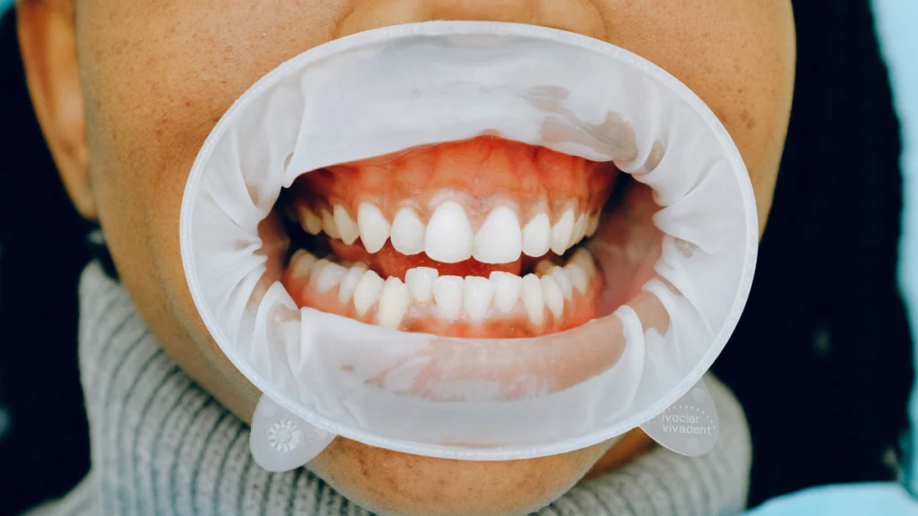 Dziąsła krwawią podczas szczotkowania? To nie jest znak, że trzeba przestać je myć Jama ustnai i zęby u dentysty