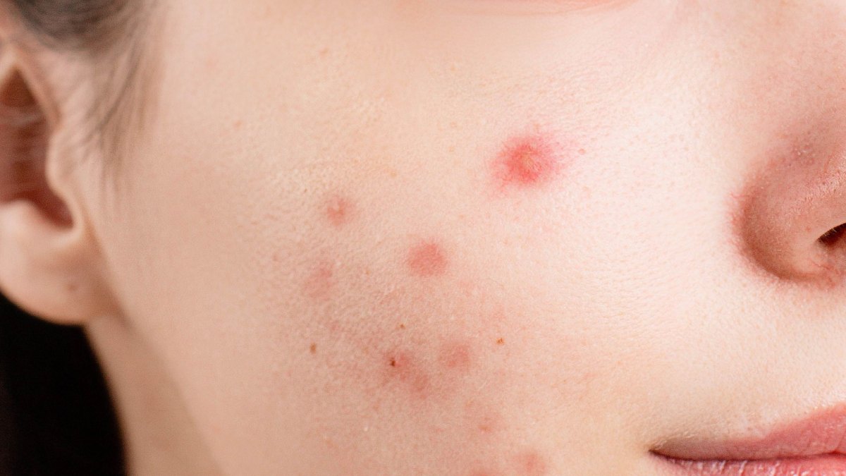 Kobieta z trądzikiem